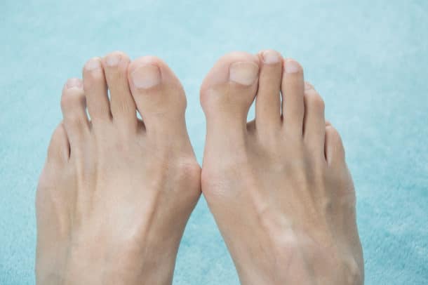 Take Control Over Your Bunions
