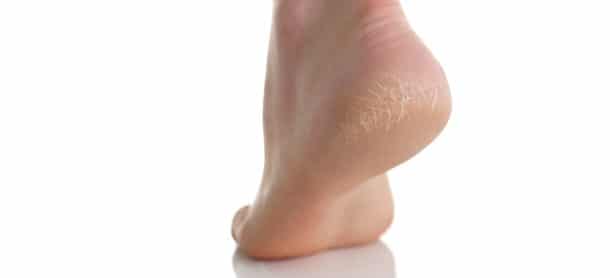Top Tips to Stop Heel Pain Before It Starts