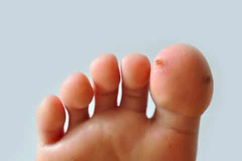 What’s the Best Way to Get Rid of Plantar Warts?