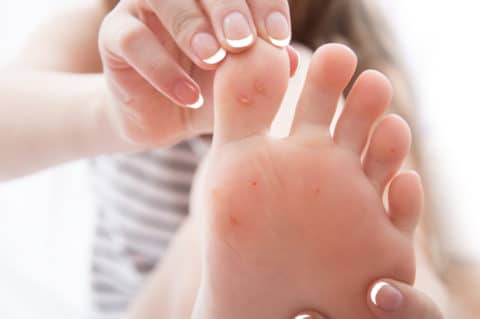 Treating Foot Warts Used to Be Miserable. Not Anymore.