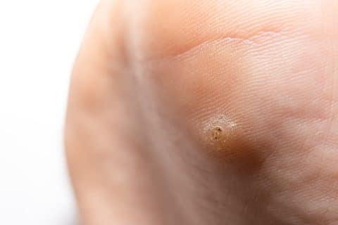 Worried About Plantar Warts? Podiatrist Answers Your Questions