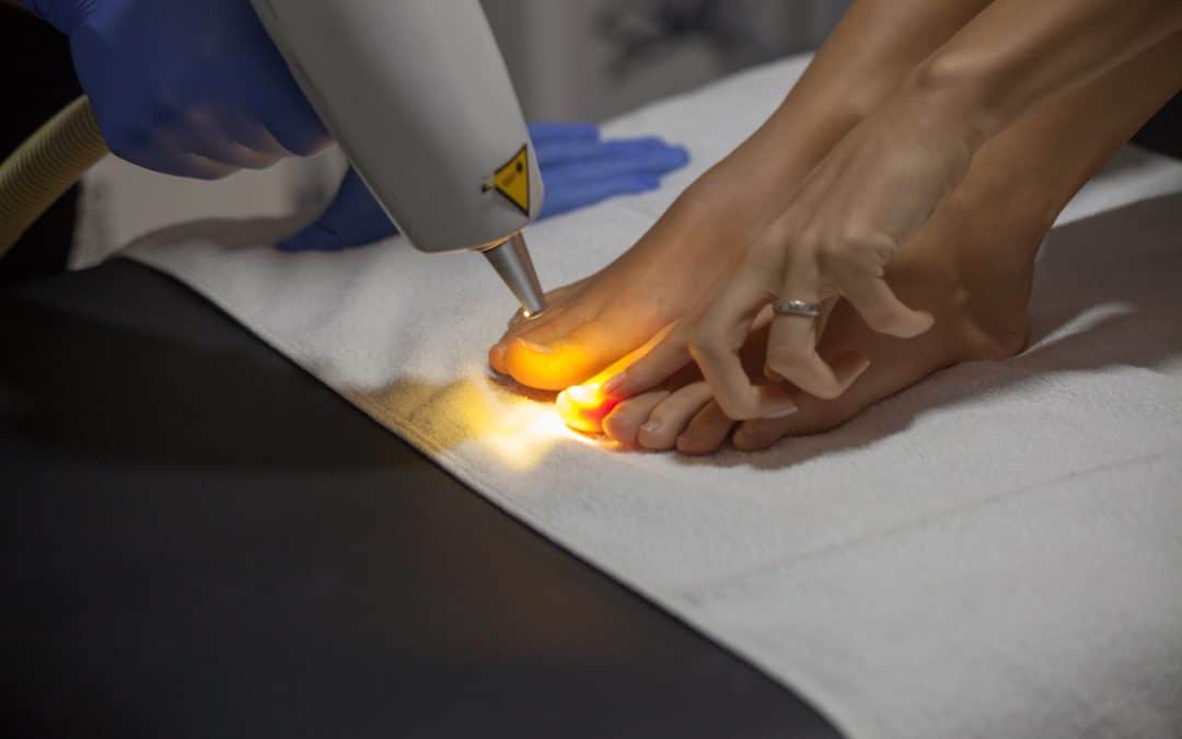 Laser Treatment for Athlete’s Foot – What You Need to Know