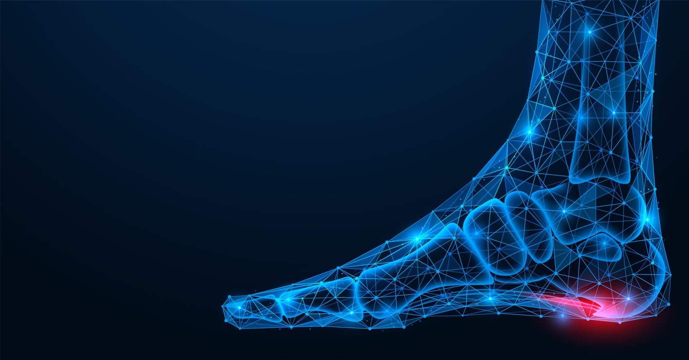 A 3D rendering of a foot showing the skin and bone in blue with a bright red pain point on the heel.