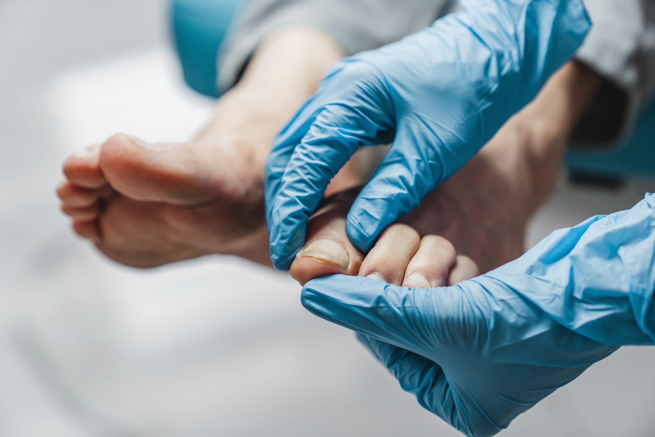 A podiatrist in blue gloves treating a patient’s nail condition on their foot.